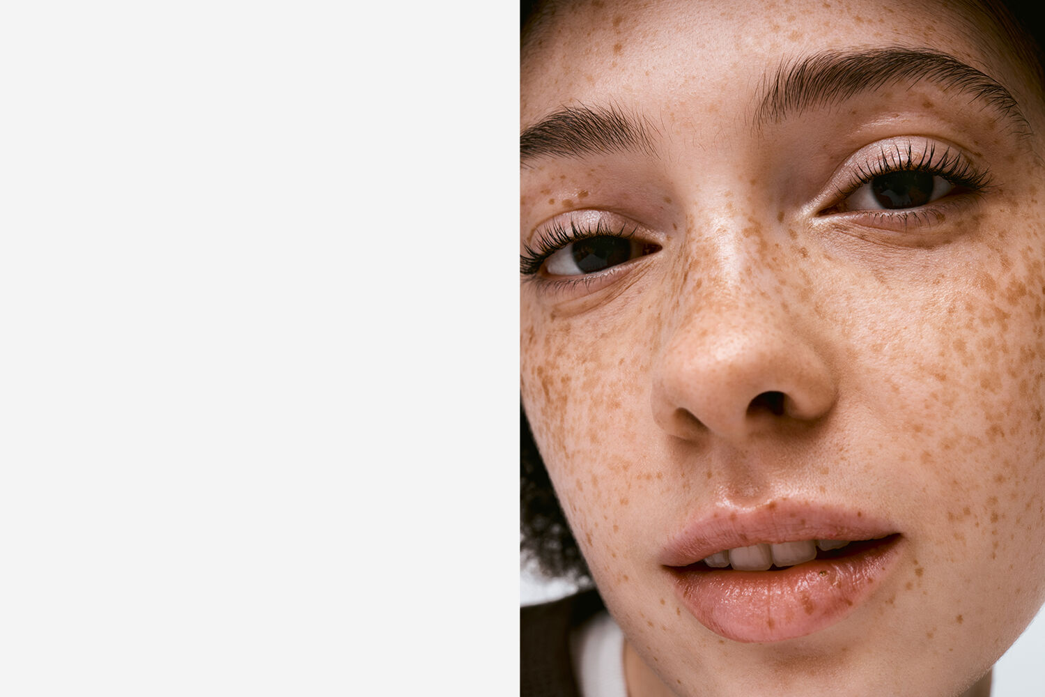 Acne-prone skin